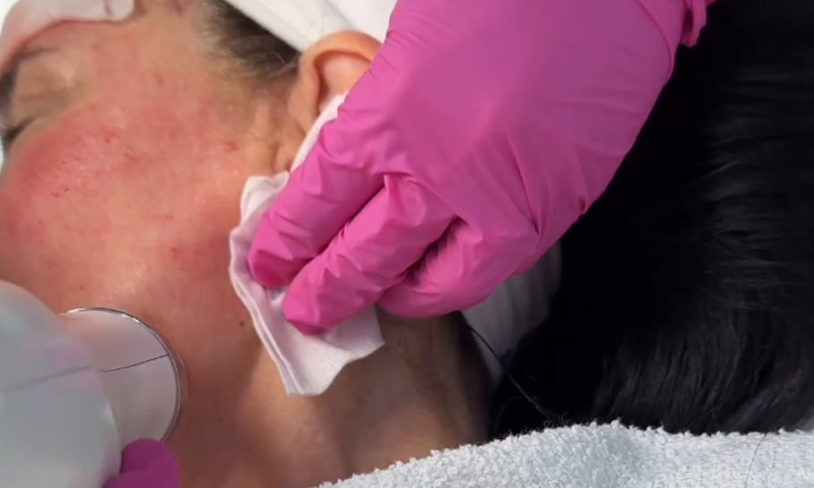 Microneedling 3
