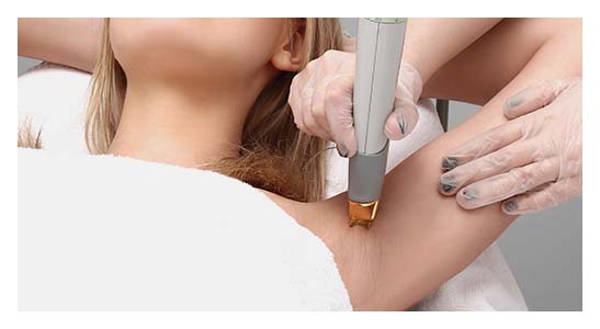 Body Laser Hair Removal