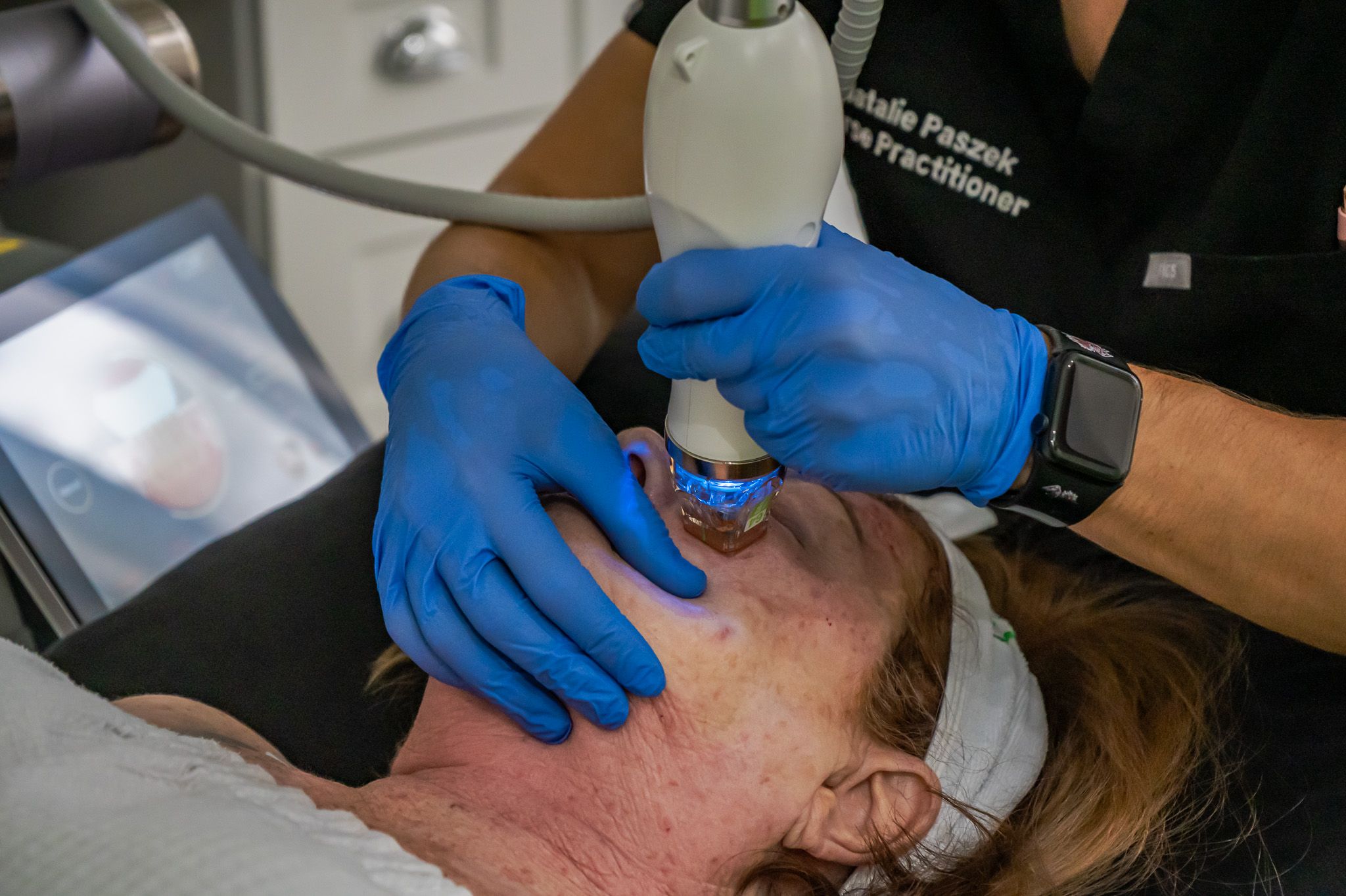 Microneedling with RF - Featured Image