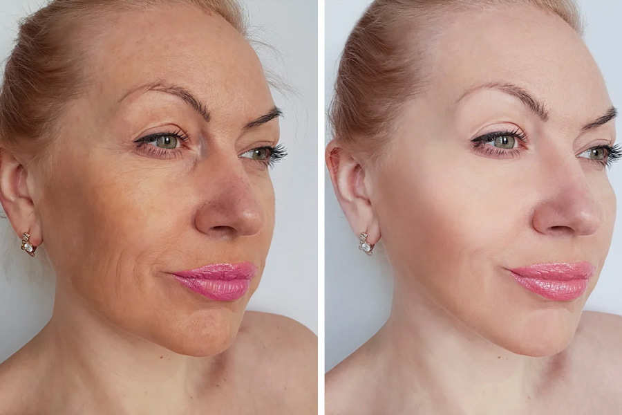 Med Spa in Hilton Head Island - Botox & Fillers