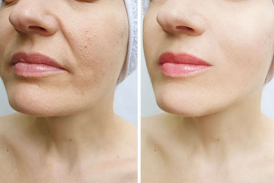 Med Spa in Hilton Head Island - IPL for Pigment and Redness