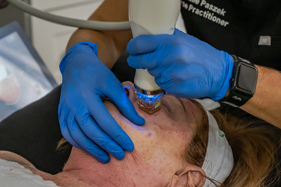 Med Spa in Hilton Head Island - Microneedling