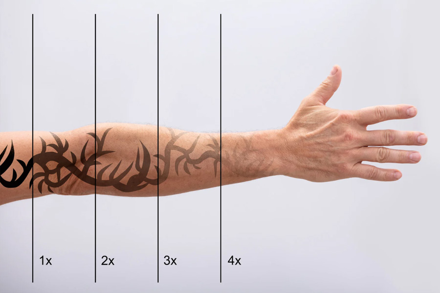 Med Spa in Hilton Head Island - Tattoo Removal