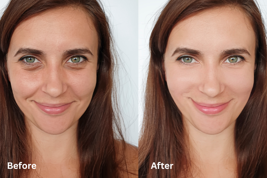 Laser Treatment - IPL Photofacial