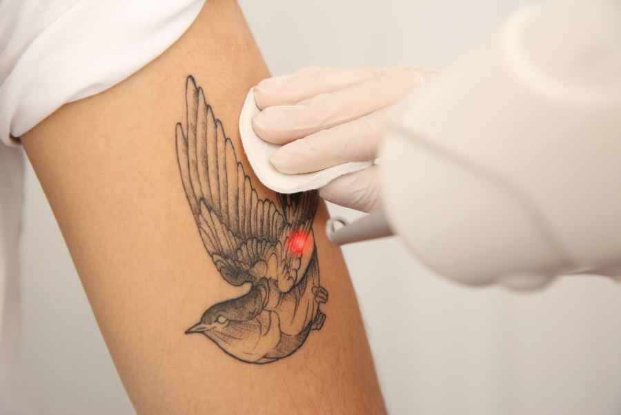 Laser Treatment - Tattoo Removal