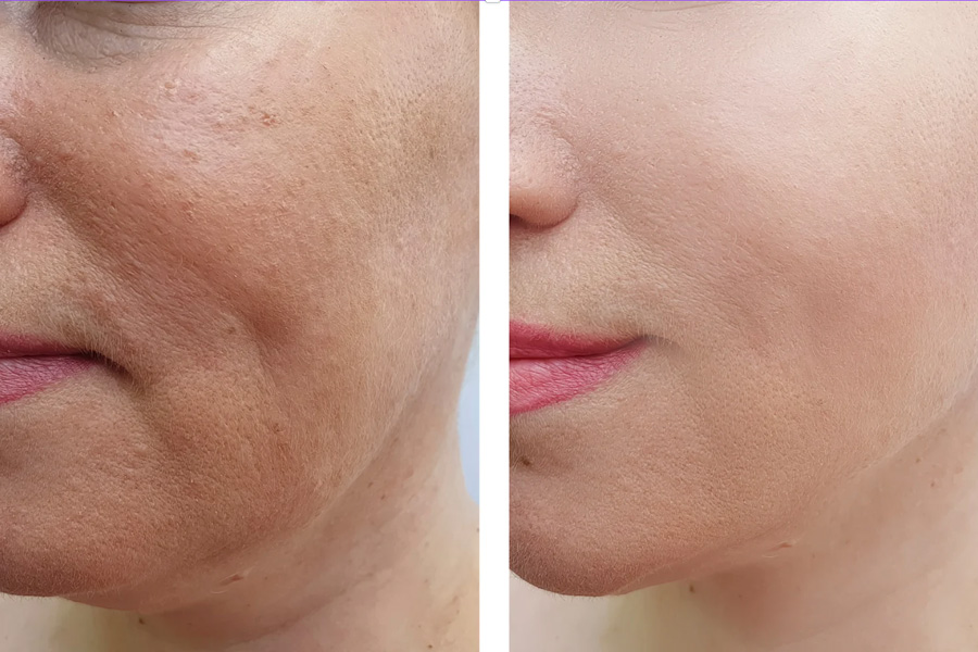 Jawline and neck skin tightening with radiofrequency treatment at Hilton Head med spa