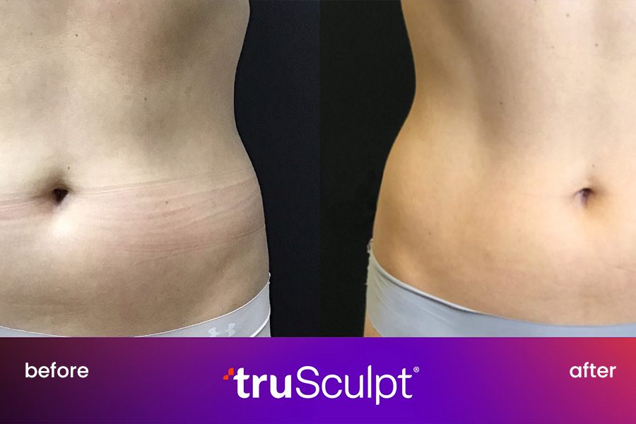 Before and after TruSculpt iD on belly showing fat reduction results