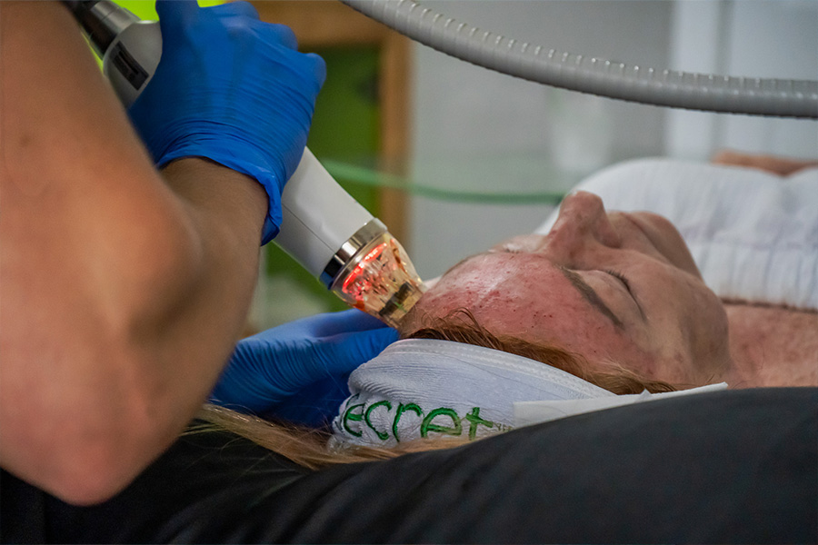 Microneedling treatment for acne scars in Hilton Head