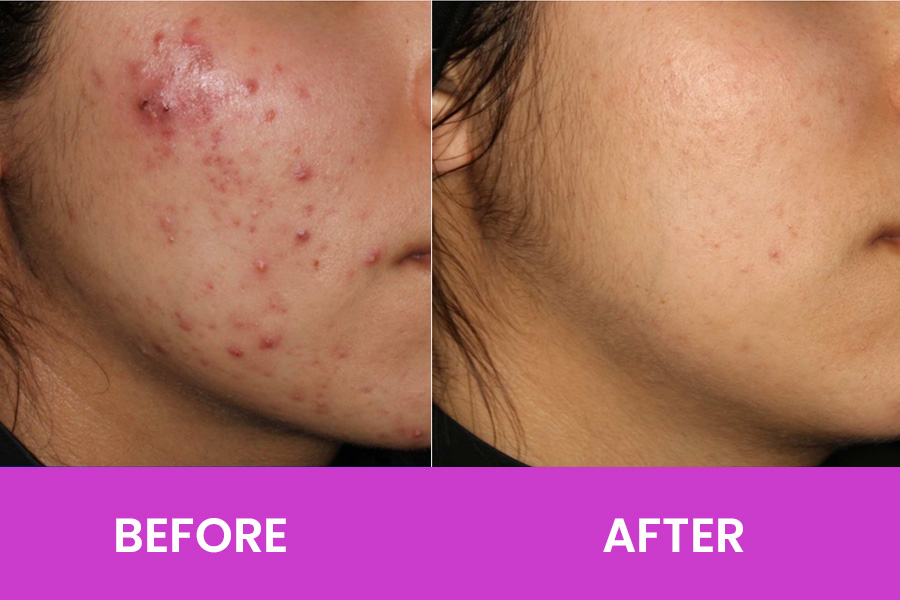 AviClear Laser Treatment Hilton Head - Before and After Acne Results