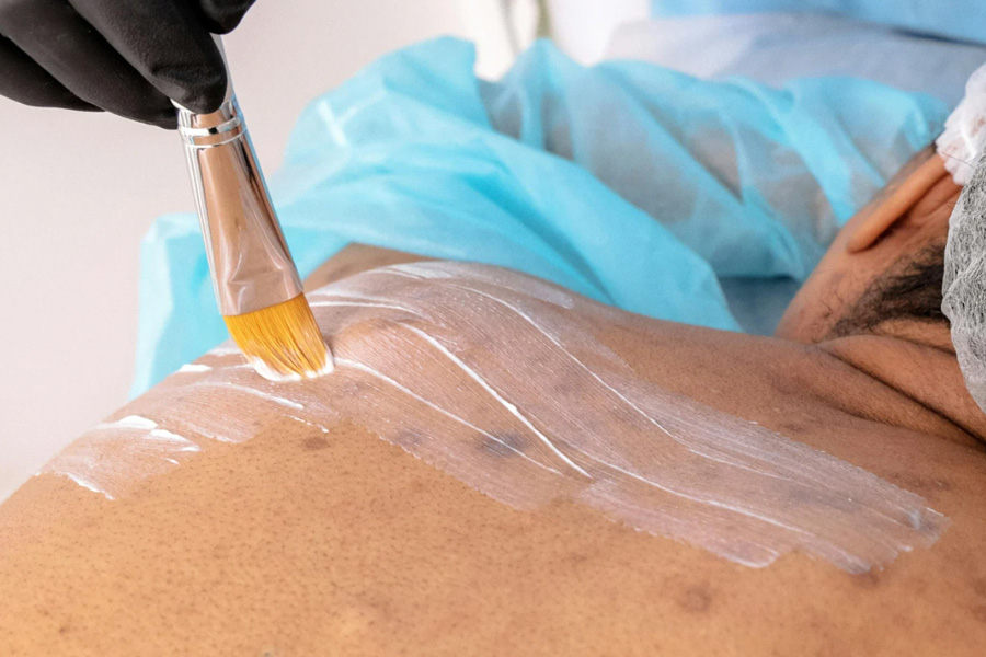Back acne treatment for men in Hilton Head using medical spa services