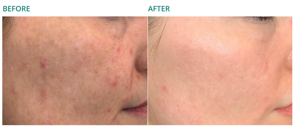 Microneedling with RF for hyperpigmentation Hilton Head