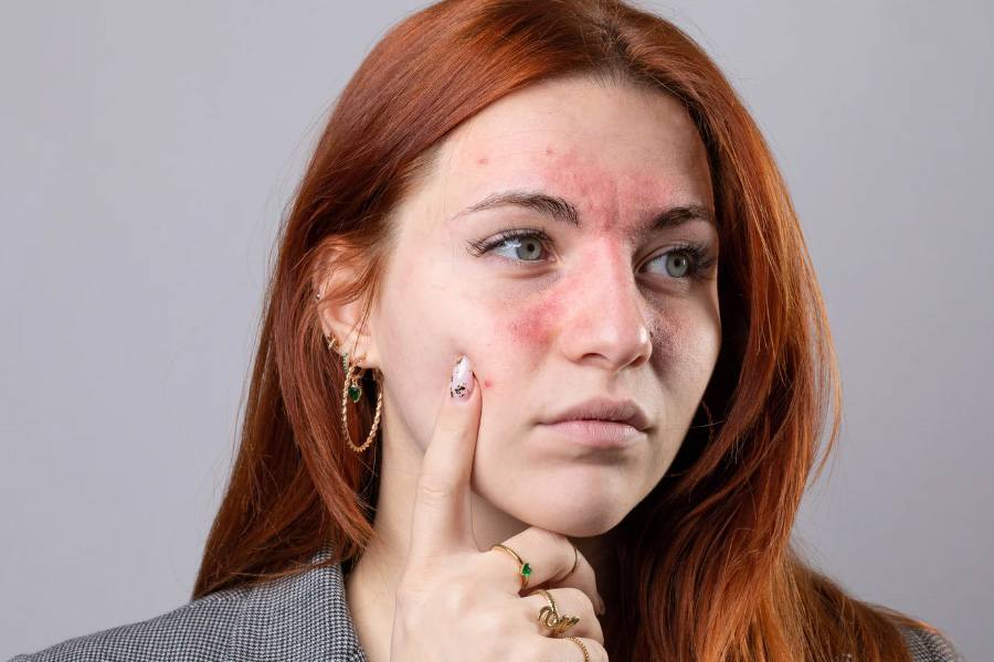 Close-up of facial redness before rosacea treatment in Hilton Head