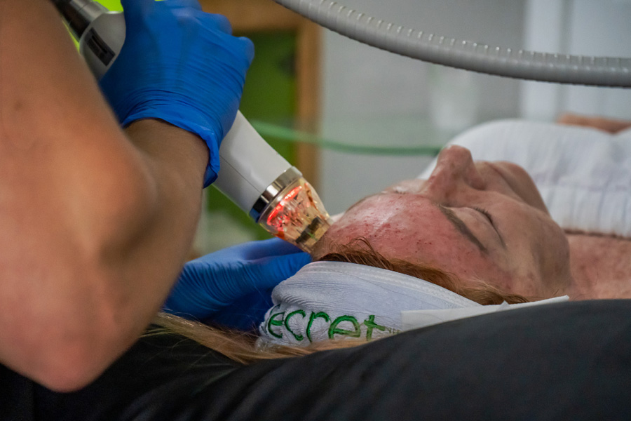 Radiofrequency microneedling treatment tightening skin after fat reduction Hilton Head