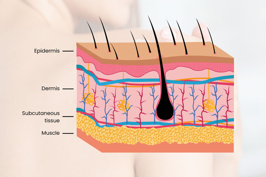 Diagram of collagen and elastin breakdown causing skin laxity