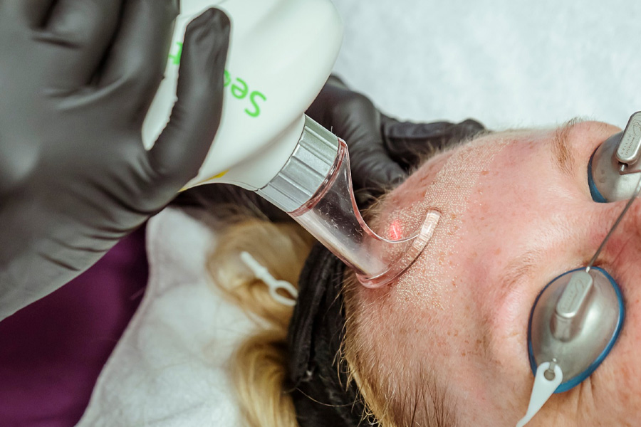 CO2 laser resurfacing scar treatment Hilton Head SC