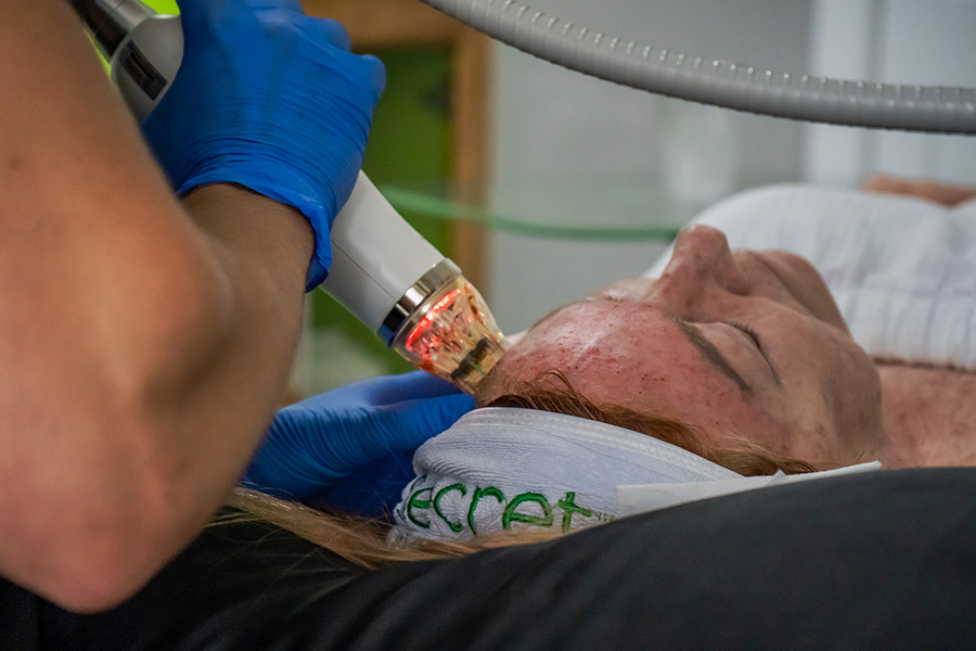 Microneedling with RF scar revision Hilton Head Island