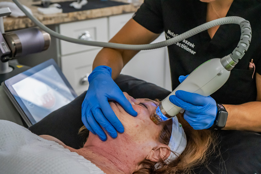 Microneedling Hilton Head for acne scars and wrinkle reduction