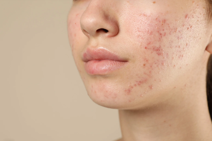 Chemical peels for acne scar treatment in Hilton Head Island