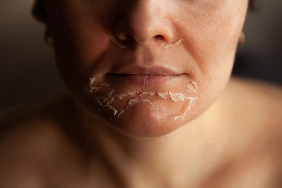 How chemical peels exfoliate and refresh skin layers