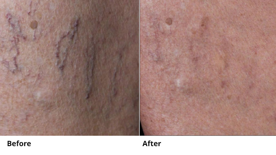 Before and after comparison of spider vein treatment results in Hilton Head