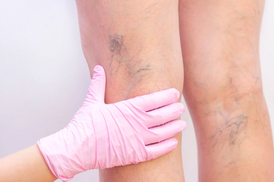 Spider vein treatment in Hilton Head