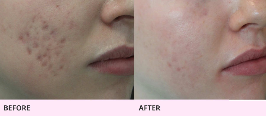 Microneedling results for acne scars in Hilton Head Island