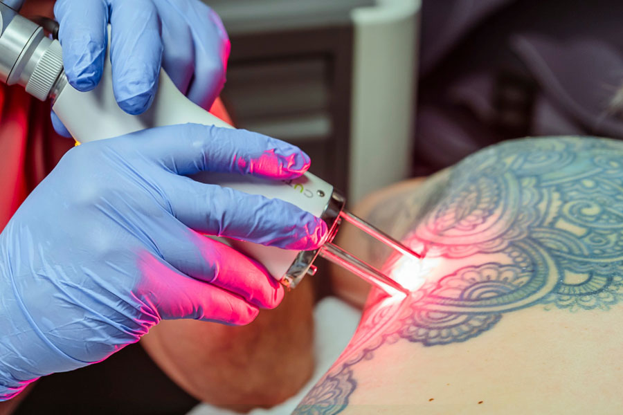 Safe tattoo removal process at medical spa in Hilton Head SC
