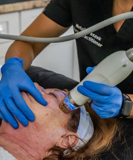 microneedling
