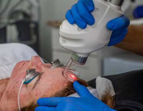 microneedling