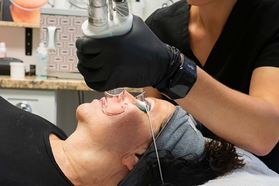 Skin resurfacing with CO2 laser treatment at medical spa in Hilton Head SC