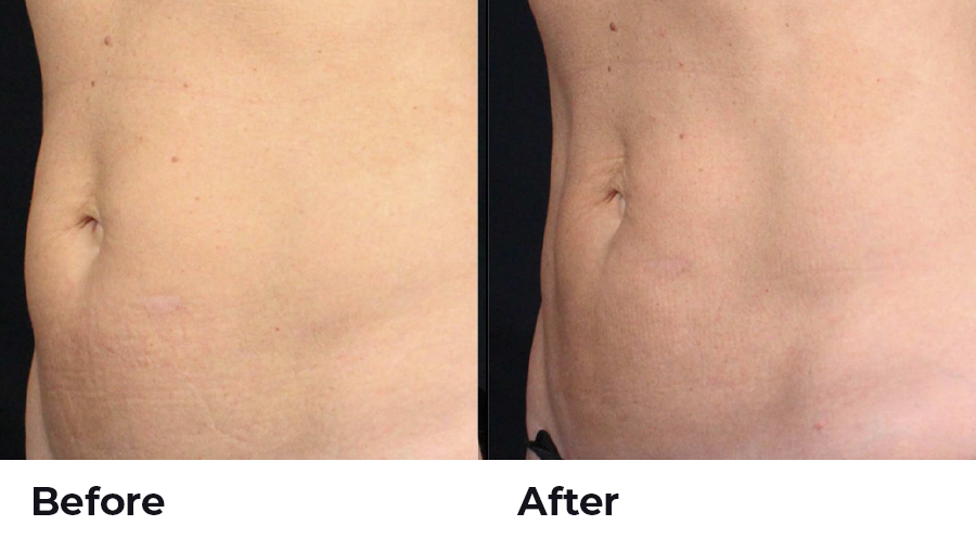 before and after body contouring week 4 results Hilton Head