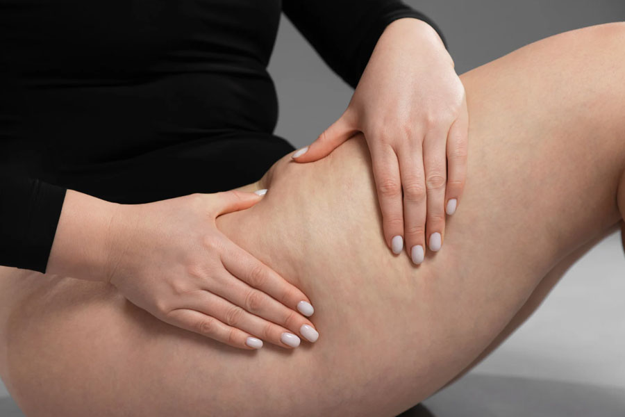 Close-up of thigh cellulite showing skin texture before cellulite treatment in Hilton Head SC