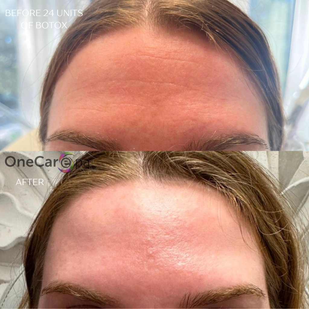 Green-Gentle-Before-and-After -Injectibles